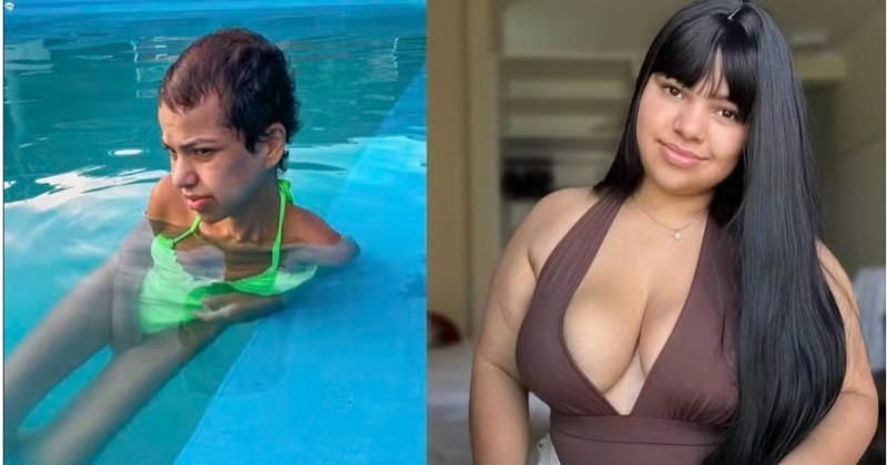 Mulher vai da obesidade com 115 Kg à desnutrição severa com 32 Kg após cirurgia bariátrica