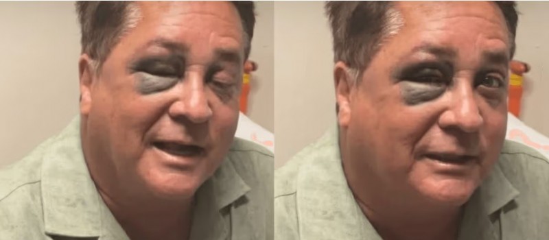 Leonardo sofre acidente em pescaria e aparece com olho roxo