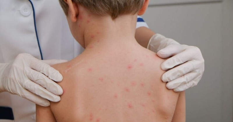 Para�ba � o 2� estado do Brasil com menos casos de meningite