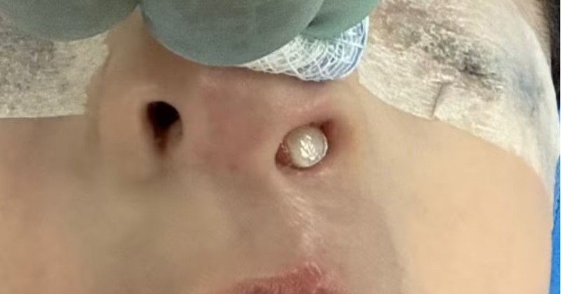 M�dica se surpreende ao descobrir dente nascendo no nariz de paciente de 3 anos