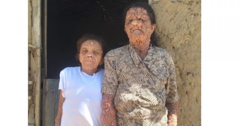 Neurofibromatose: m�e e filha na Para�ba convivem com doen�a rara que atravessa gera��es