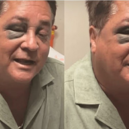 Leonardo sofre acidente em pescaria e aparece com olho roxo