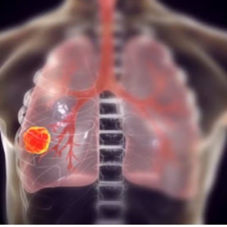 Vacina para prevenir cncer de pulmo inicia estudos em humanos
