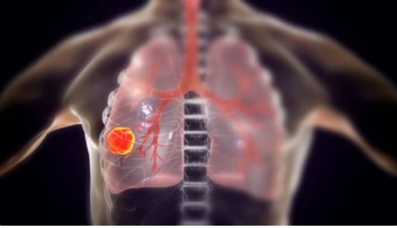 Vacina para prevenir cncer de pulmo inicia estudos em humanos